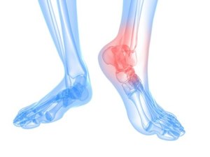 Arthritic feet