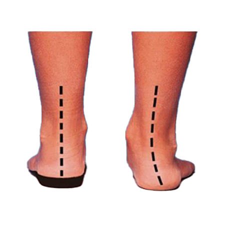 Foot Orthotics