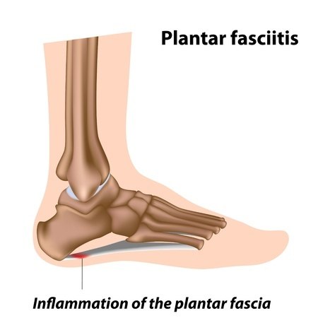 Heel and foot pain